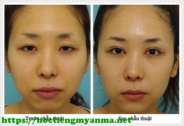 bấm m&iacute; h&agrave;n quốc đẹp tự nhi&ecirc;n